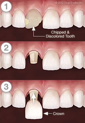 Dental Crowns Step by Step - Lincoln NE 