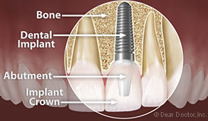 Dental Implants South Lincoln NE