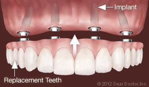 Dental Implants in Lincoln, NE