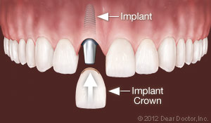 Dental Implants in South Lincoln, NE